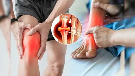 Icexin gél felvitelére alkalmas bőrterületek (térd, könyök, hát alsó része)