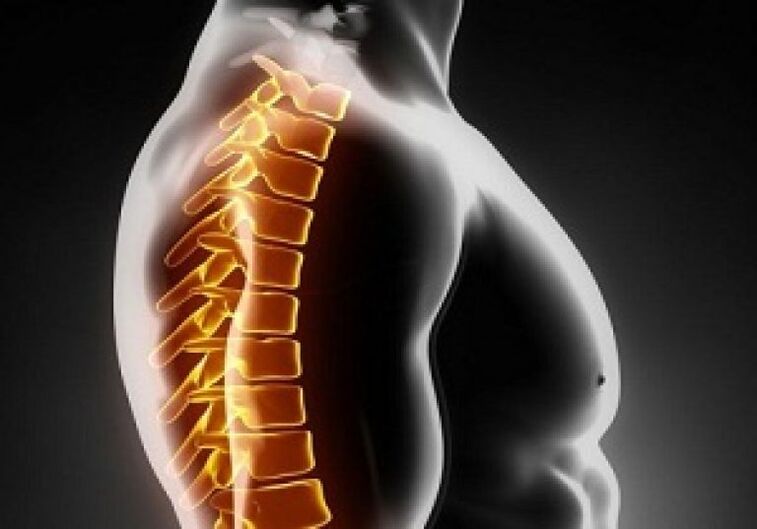 A mellkasi osteochondrosis fájdalmat és kényelmetlenséget kísér a hát közepén