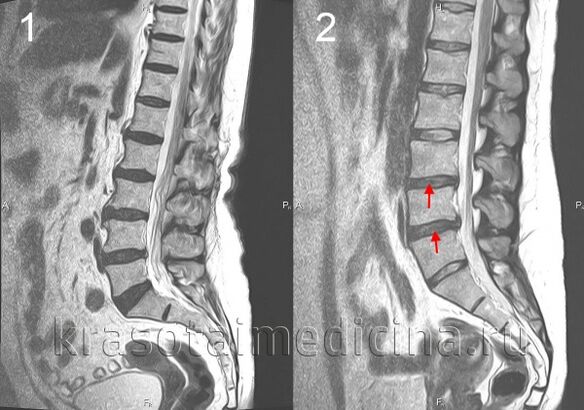gerinc osteochondrosis