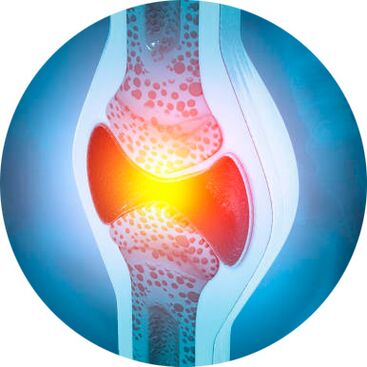 ízületi helyreállítási eljárás Icexin géllel